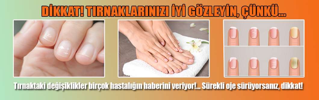 Tırnaktaki değişiklikler birçok hastalığın haberini veriyor!